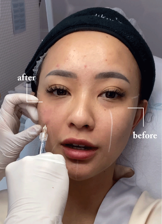 MedikPro Face Sculpting Injecting Green Filler to Fix Under Eye Hollow